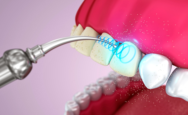 Удаление зуба с помощью ультазвука