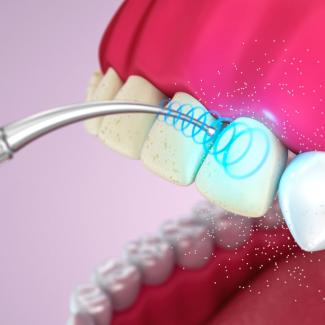 Удаляем зубы с помощью ультразвука
